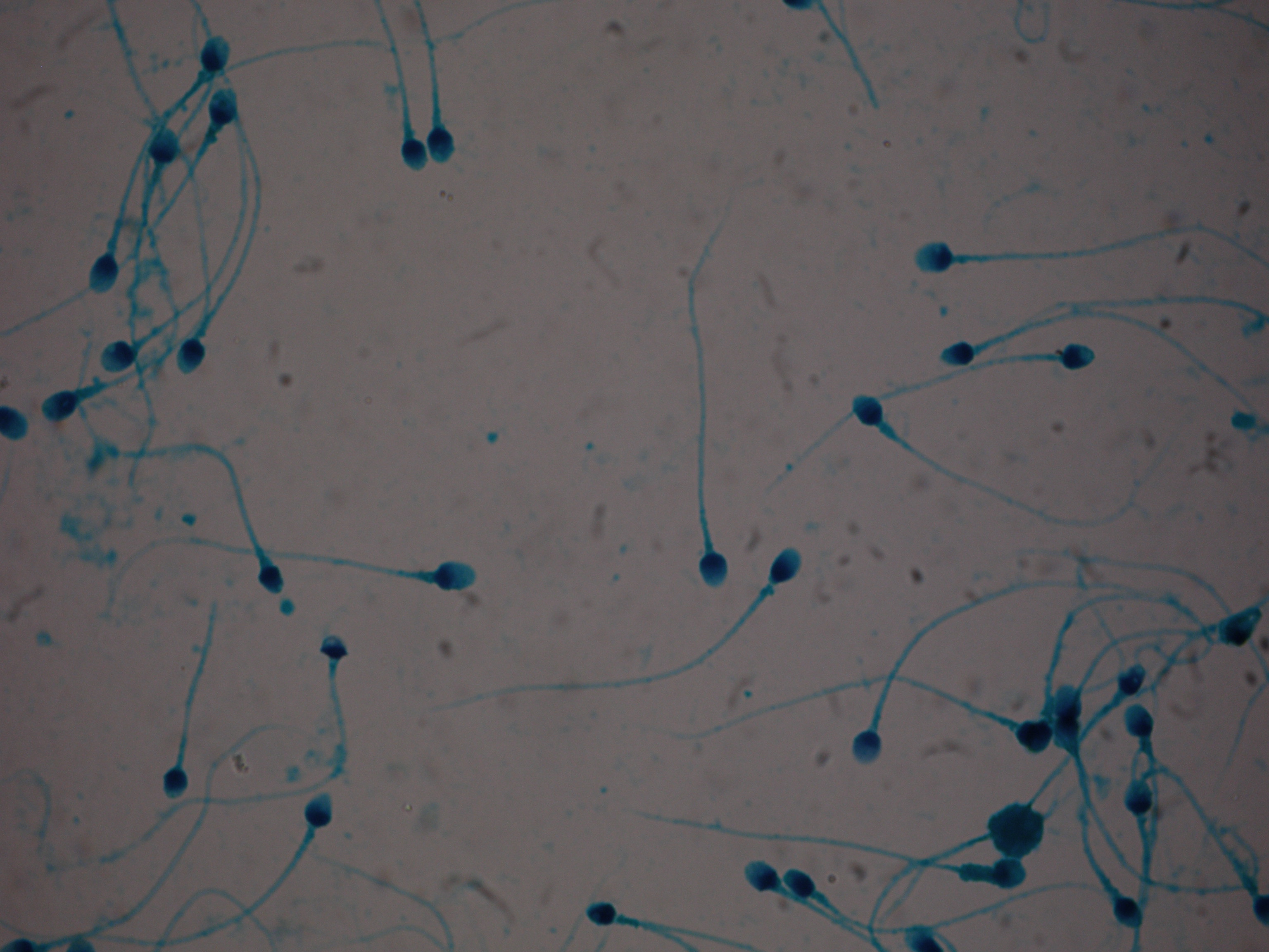 Temel İnfertilite